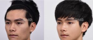 %ec%95%9e%ea%b4%91%eb%8c%80%ec%88%98%ec%88%a0%ec%9d%80-%ec%96%b4%eb%96%bb%ea%b2%8c-%ed%95%98%eb%8a%94%ea%b1%b0%ec%97%90%ec%9a%94