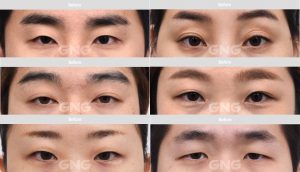 %ec%a7%80%ec%95%a4%ec%a7%80%eb%b3%91%ec%9b%90-%ec%84%b1%ed%98%95%ec%99%b8%ea%b3%bc-%eb%88%88%eb%a7%a4%ea%b5%90%ec%a0%95%ed%9b%84%ea%b8%b0-%ec%82%ac%ec%a7%84-%ec%9d%b4%eb%a0%87%ea%b2%8c%eb%82%98